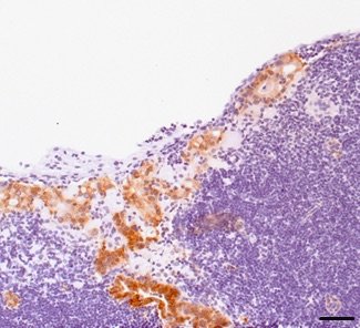 Metastasenbildung-Dickdarmkrebs